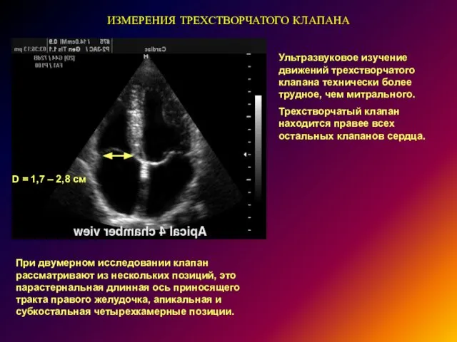 ИЗМЕРЕНИЯ ТРЕХСТВОРЧАТОГО КЛАПАНА D = 1,7 – 2,8 см Ультразвуковое изучение