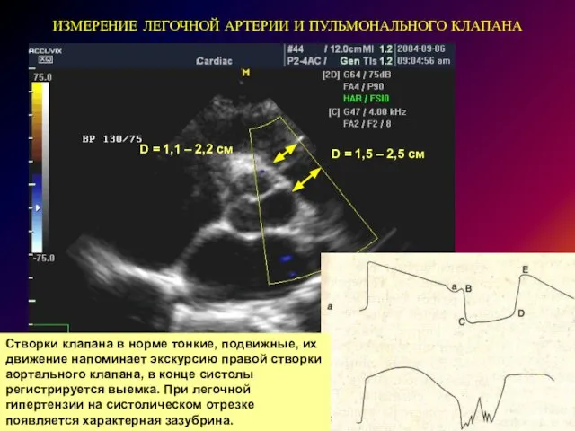 ИЗМЕРЕНИЕ ЛЕГОЧНОЙ АРТЕРИИ И ПУЛЬМОНАЛЬНОГО КЛАПАНА Створки клапана в норме тонкие,