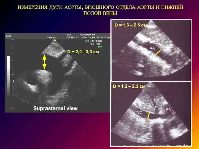 ИЗМЕРЕНИЯ ДУГИ АОРТЫ, БРЮШНОГО ОТДЕЛА АОРТЫ И НИЖНЕЙ ПОЛОЙ ВЕНЫ D