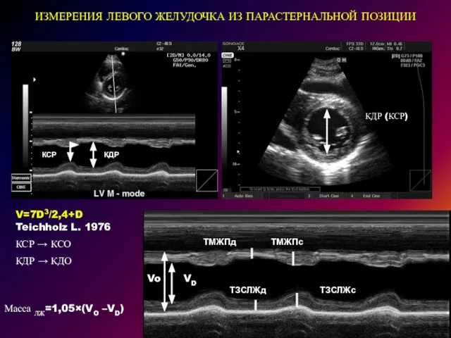 ИЗМЕРЕНИЯ ЛЕВОГО ЖЕЛУДОЧКА ИЗ ПАРАСТЕРНАЛЬНОЙ ПОЗИЦИИ V=7D3/2,4+D Teichholz L. 1976 КСР