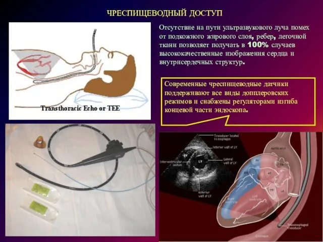 ЧРЕСПИЩЕВОДНЫЙ ДОСТУП Отсутствие на пути ультразвукового луча помех от подкожного жирового