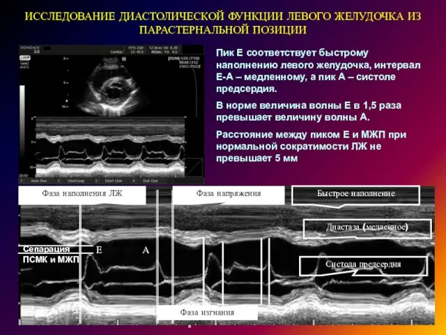 ИССЛЕДОВАНИЕ ДИАСТОЛИЧЕСКОЙ ФУНКЦИИ ЛЕВОГО ЖЕЛУДОЧКА ИЗ ПАРАСТЕРНАЛЬНОЙ ПОЗИЦИИ Пик Е соответствует