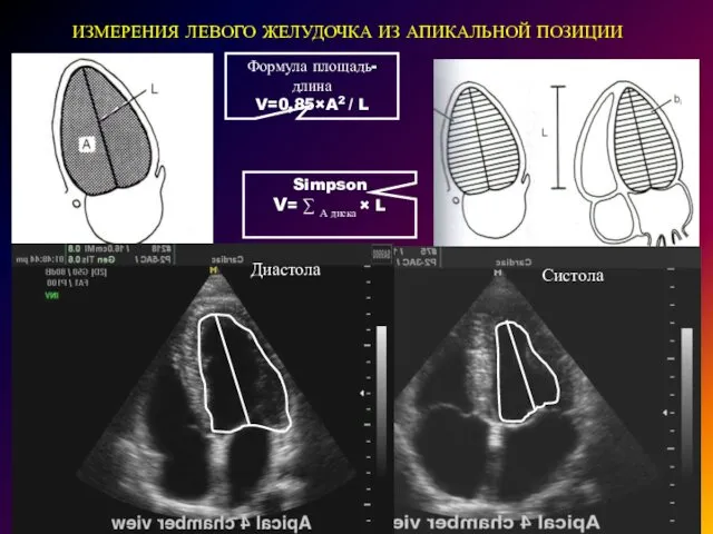 ИЗМЕРЕНИЯ ЛЕВОГО ЖЕЛУДОЧКА ИЗ АПИКАЛЬНОЙ ПОЗИЦИИ Формула площадь-длина V=0,85×A2 / L