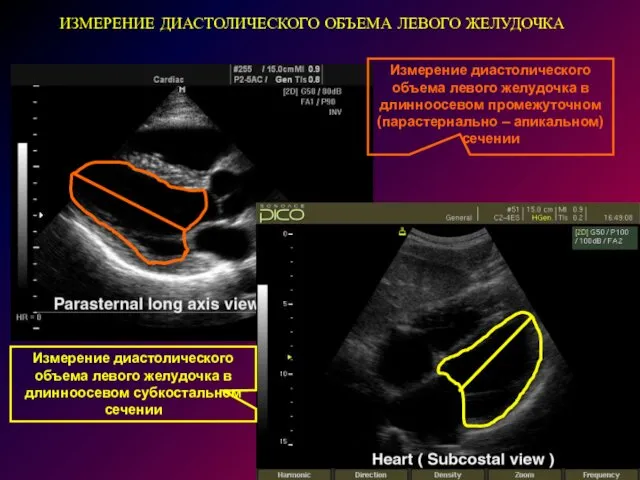 ИЗМЕРЕНИЕ ДИАСТОЛИЧЕСКОГО ОБЪЕМА ЛЕВОГО ЖЕЛУДОЧКА Измерение диастолического объема левого желудочка в
