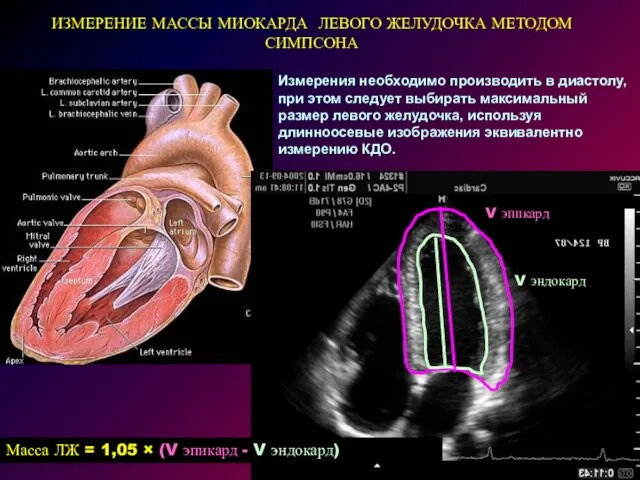 ИЗМЕРЕНИЕ МАССЫ МИОКАРДА ЛЕВОГО ЖЕЛУДОЧКА МЕТОДОМ СИМПСОНА Измерения необходимо производить в