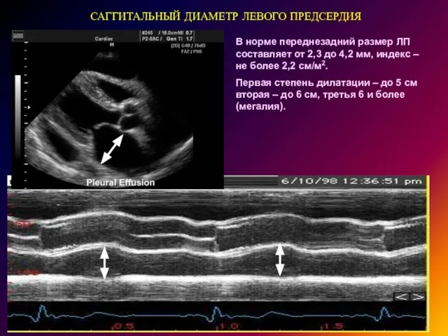 САГГИТАЛЬНЫЙ ДИАМЕТР ЛЕВОГО ПРЕДСЕРДИЯ В норме переднезадний размер ЛП составляет от