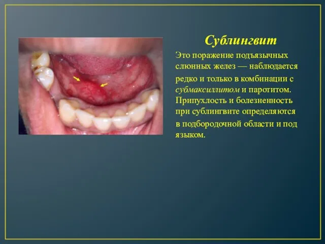 Сублингвит Это поражение подъязычных слюнных желез — наблюдается редко и только