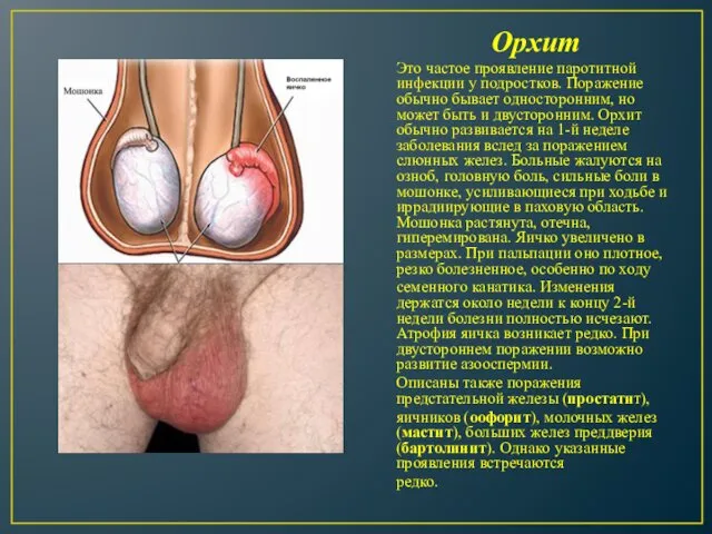 Орхит Это частое проявление паротитной инфекции у подростков. Поражение обычно бывает