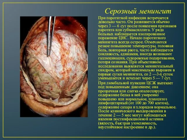 Серозный менингит При паротитной инфекции встречается довольно часто. Он развивается обычно
