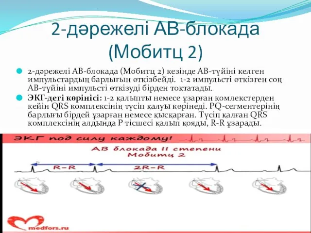 2-дәрежелі АВ-блокада (Мобитц 2) 2-дәрежелі АВ-блокада (Мобитц 2) кезінде АВ-түйіні келген