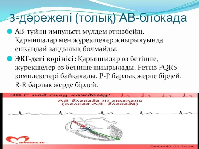 3-дәрежелі (толық) АВ-блокада АВ-түйіні импульсті мүлдем өткізбейді. Қарыншалар мен жүрекшелер жиырылуында