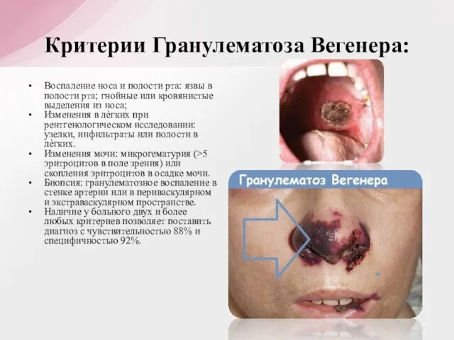 Воспаление носа и полости рта: язвы в полости рта; гнойные или
