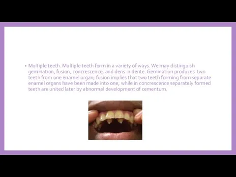 Multiple teeth. Multiple teeth form in a variety of ways. We