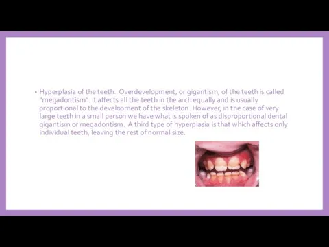 Hyperplasia of the teeth. Overdevelopment, or gigantism, of the teeth is