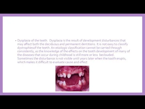 Dysplasia of the teeth. Dysplasia is the result of development disturbances