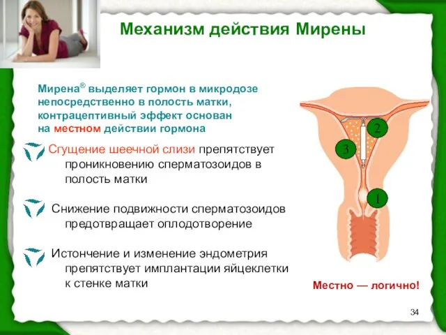 Мирена® выделяет гормон в микродозе непосредственно в полость матки, контрацептивный эффект