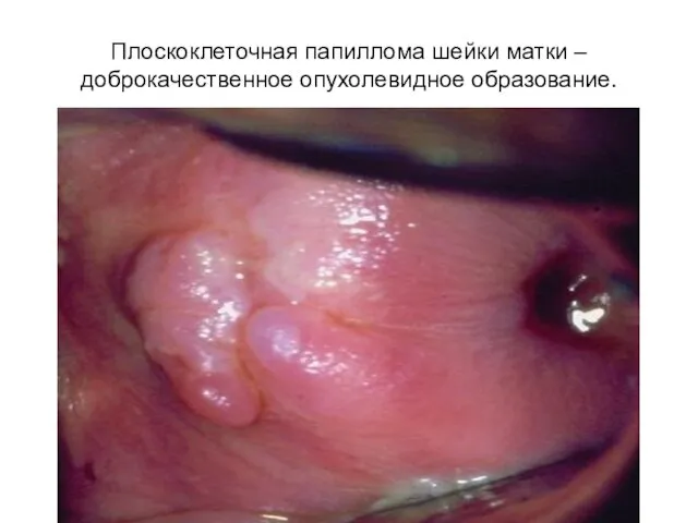 Плоскоклеточная папиллома шейки матки – доброкачественное опухолевидное образование.