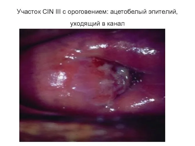 Участок CIN III c ороговением: ацетобелый эпителий, уходящий в канал