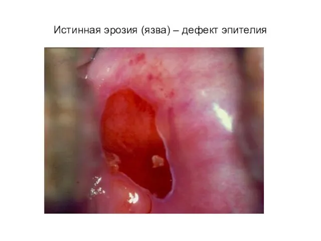 Истинная эрозия (язва) – дефект эпителия