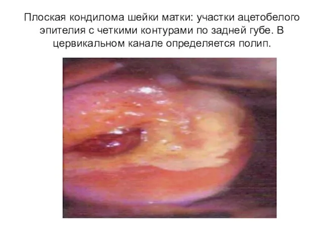 Плоская кондилома шейки матки: участки ацетобелого эпителия с четкими контурами по