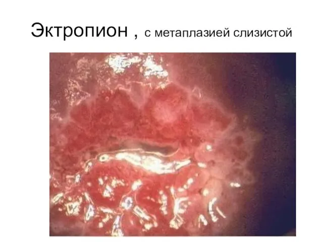 Эктропион , с метаплазией слизистой