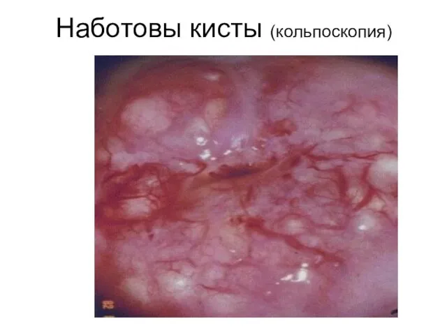 Наботовы кисты (кольпоскопия)