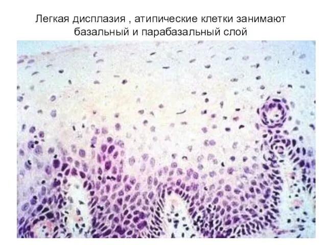 Легкая дисплазия , атипические клетки занимают базальный и парабазальный слой