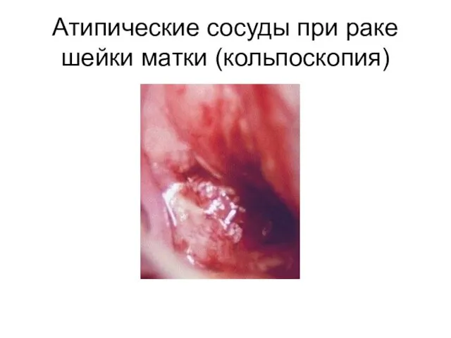 Атипические сосуды при раке шейки матки (кольпоскопия)