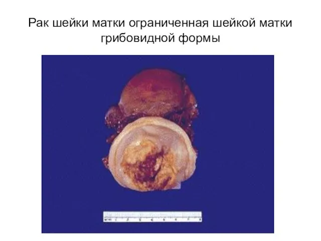 Рак шейки матки ограниченная шейкой матки грибовидной формы
