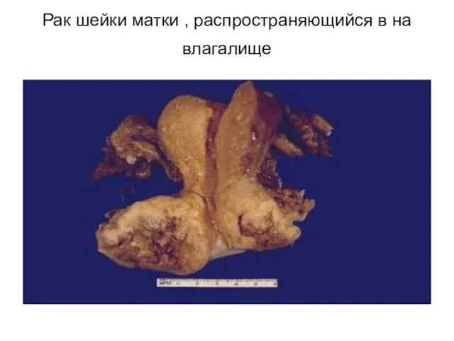 Рак шейки матки , распространяющийся в на влагалище