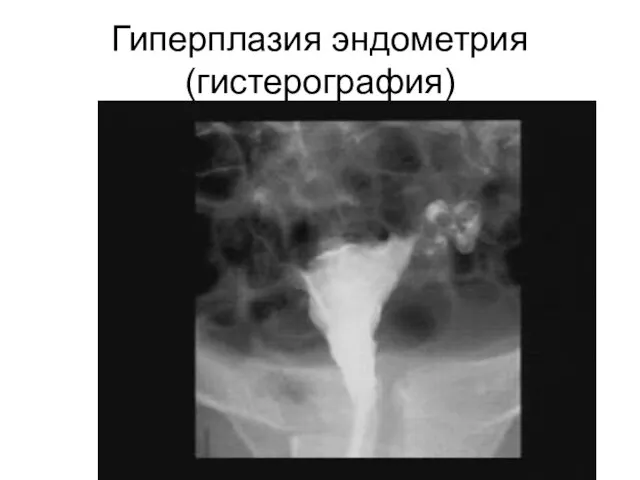 Гиперплазия эндометрия (гистерография)