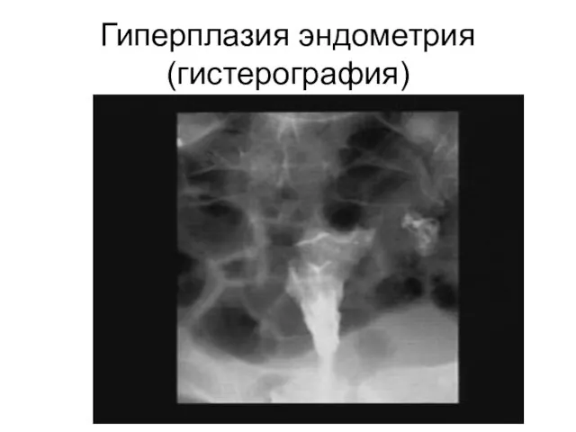 Гиперплазия эндометрия (гистерография)