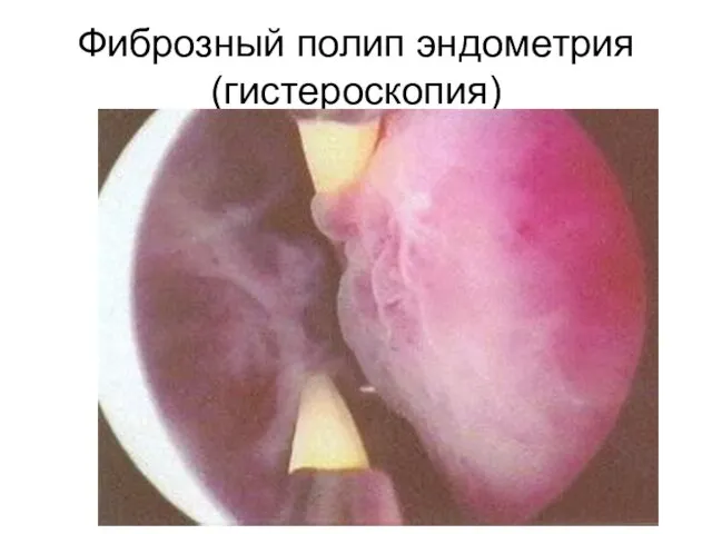 Фиброзный полип эндометрия (гистероскопия)