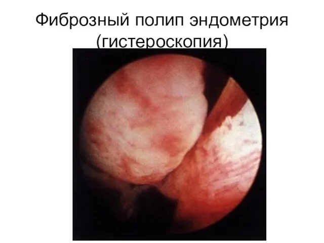 Фиброзный полип эндометрия (гистероскопия)
