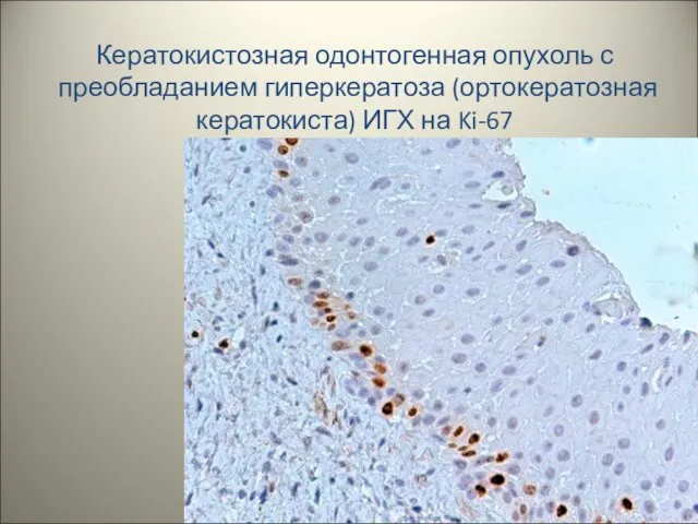 Кератокистозная одонтогенная опухоль с преобладанием гиперкератоза (ортокератозная кератокиста) ИГХ на Ki-67