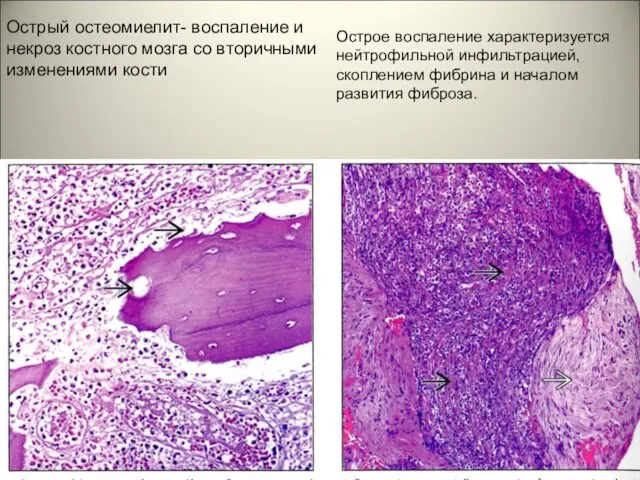 Острый остеомиелит- воспаление и некроз костного мозга со вторичными изменениями кости