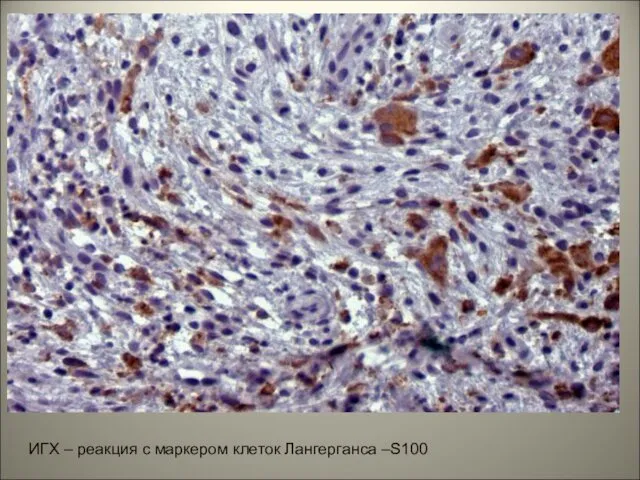 ИГХ – реакция с маркером клеток Лангерганса –S100