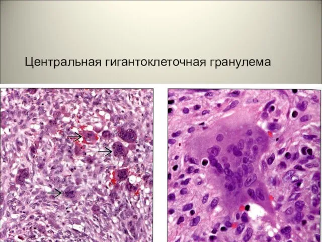 Центральная гигантоклеточная гранулема