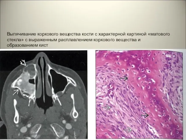 Выпячивание коркового вещества кости с характерной картиной «матового стекла» с выраженным