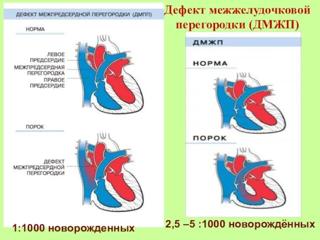 1:1000 новорожденных 2,5 –5 :1000 новорождённых Дефект межжелудочковой перегородки (ДМЖП)