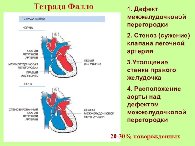 1. Дефект межжелудочковой перегородки 2. Стеноз (сужение) клапана легочной артерии 3.Утолщение