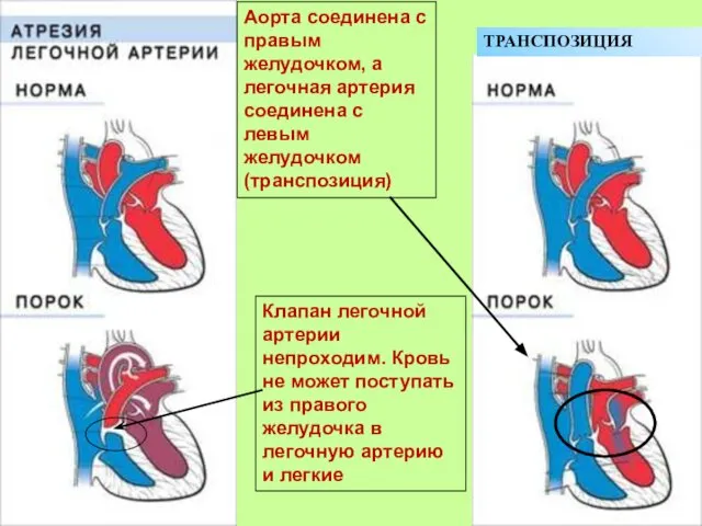 Клапан легочной артерии непроходим. Кровь не может поступать из правого желудочка