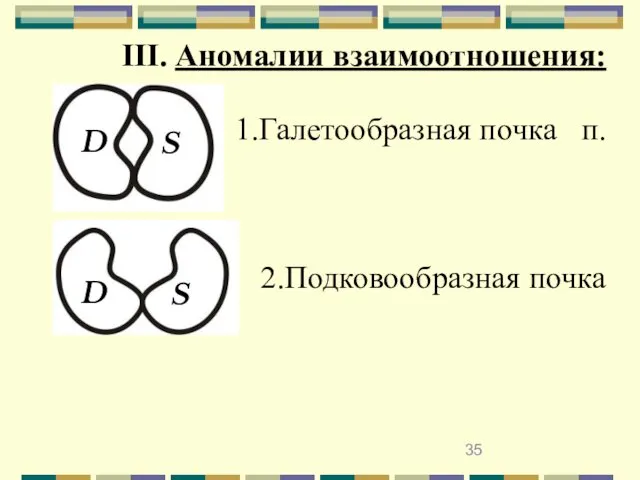 III. Аномалии взаимоотношения: 1.Галетообразная почка п. 2.Подковообразная почка D S D S