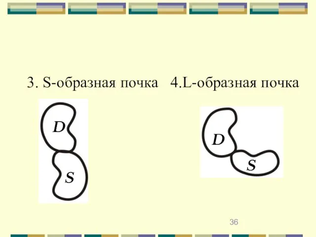 3. S-образная почка 4.L-образная почка D D S S