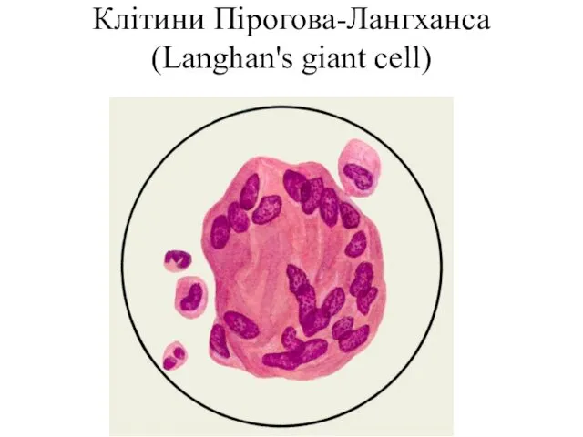 Клітини Пірогова-Лангханса (Langhan's giant cell)
