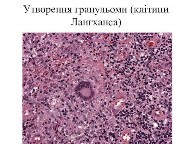 Утворення гранульоми (клітини Лангханса)