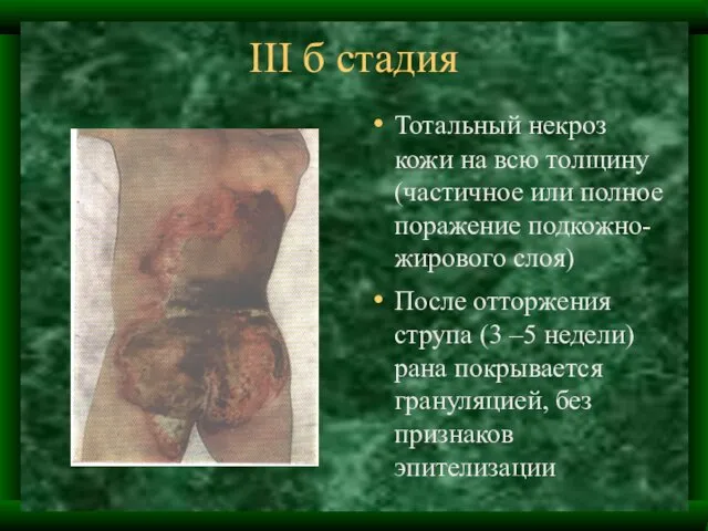 III б стадия Тотальный некроз кожи на всю толщину (частичное или