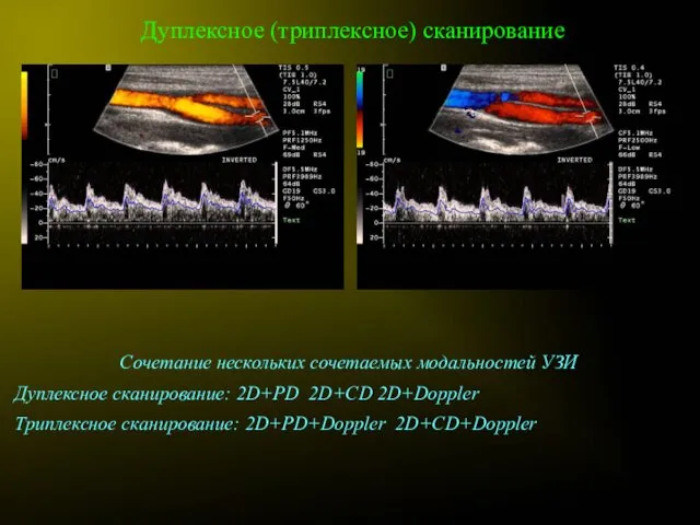 Дуплексное (триплексное) сканирование Сочетание нескольких сочетаемых модальностей УЗИ Дуплексное сканирование: 2D+PD