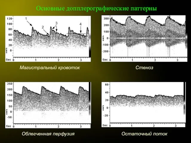 Основные допплерографические паттерны Магистральный кровоток Стеноз Облегченная перфузия Остаточный поток