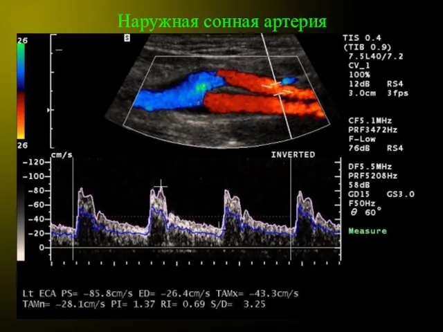 Наружная сонная артерия